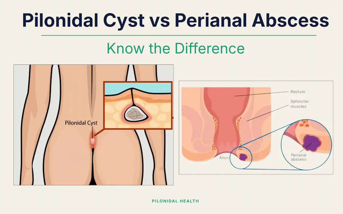 Perianal Abscess vs Pilonidal Cyst: How to Tell the Difference