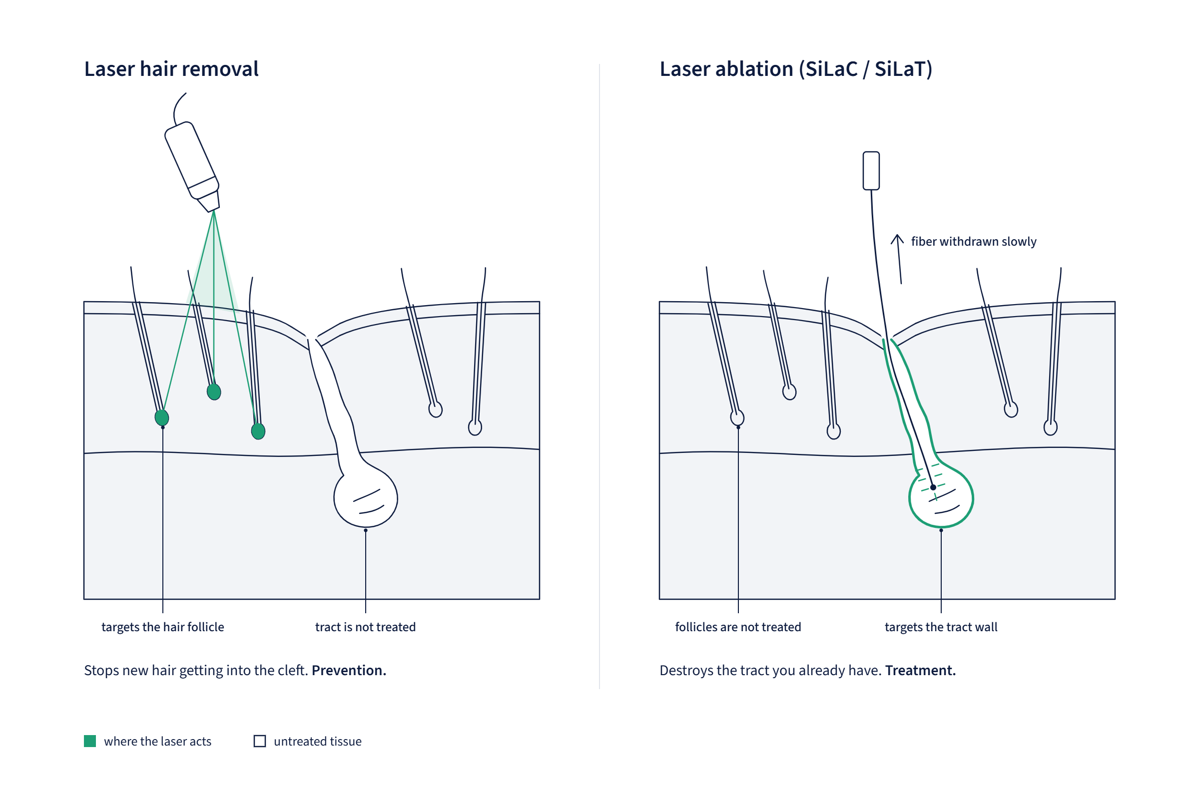 Pilonidal Cyst Laser Treatment: Hair Removal vs Laser Surgery